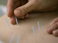 Acupunctura - Reflexoterapie